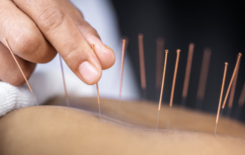 Acupuncture